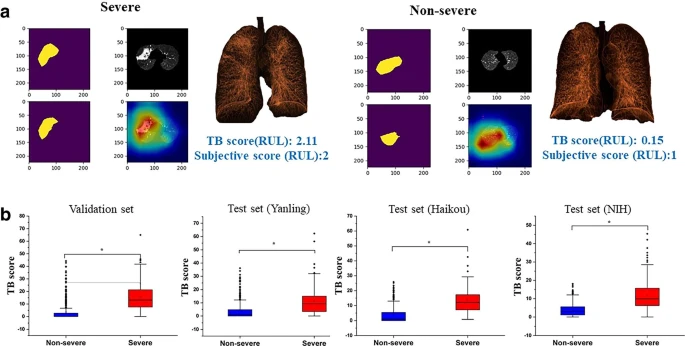 (a) AI-identified suspicious infectious areas on images of severe and non-severe disease. Pseudocolor map represents the three-dimensional reconstruction of the lesion. (b) Boxplots comparing TB scores per lobe between severe and non-severe patients for the validation and test datasets.