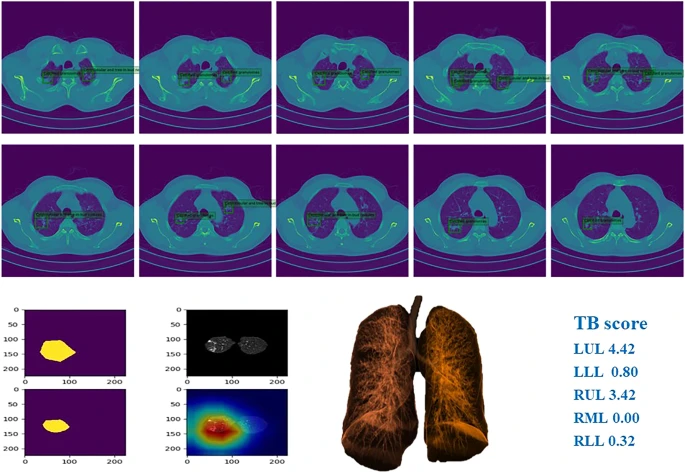 Example of chest CT images of patients with pulmonary TB and performance of our AI model.