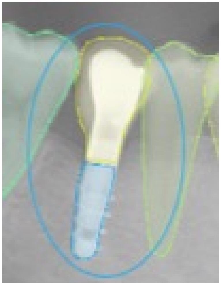 This selected view of Figure 1 shows the correct detection in the right position of an implant. The assigned value was TP.