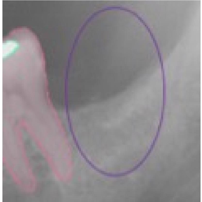 This selected view of Figure 1 shows the correct detection in the right position of an absent tooth in position 3.7. The assigned value was TN.