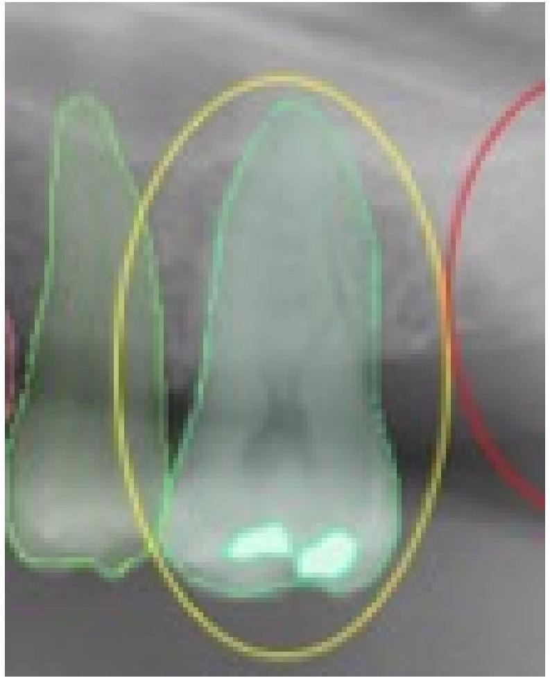 This selected view of Figure 1 shows the missing detection of the tooth filling in position 2.6. The assigned value was FN.