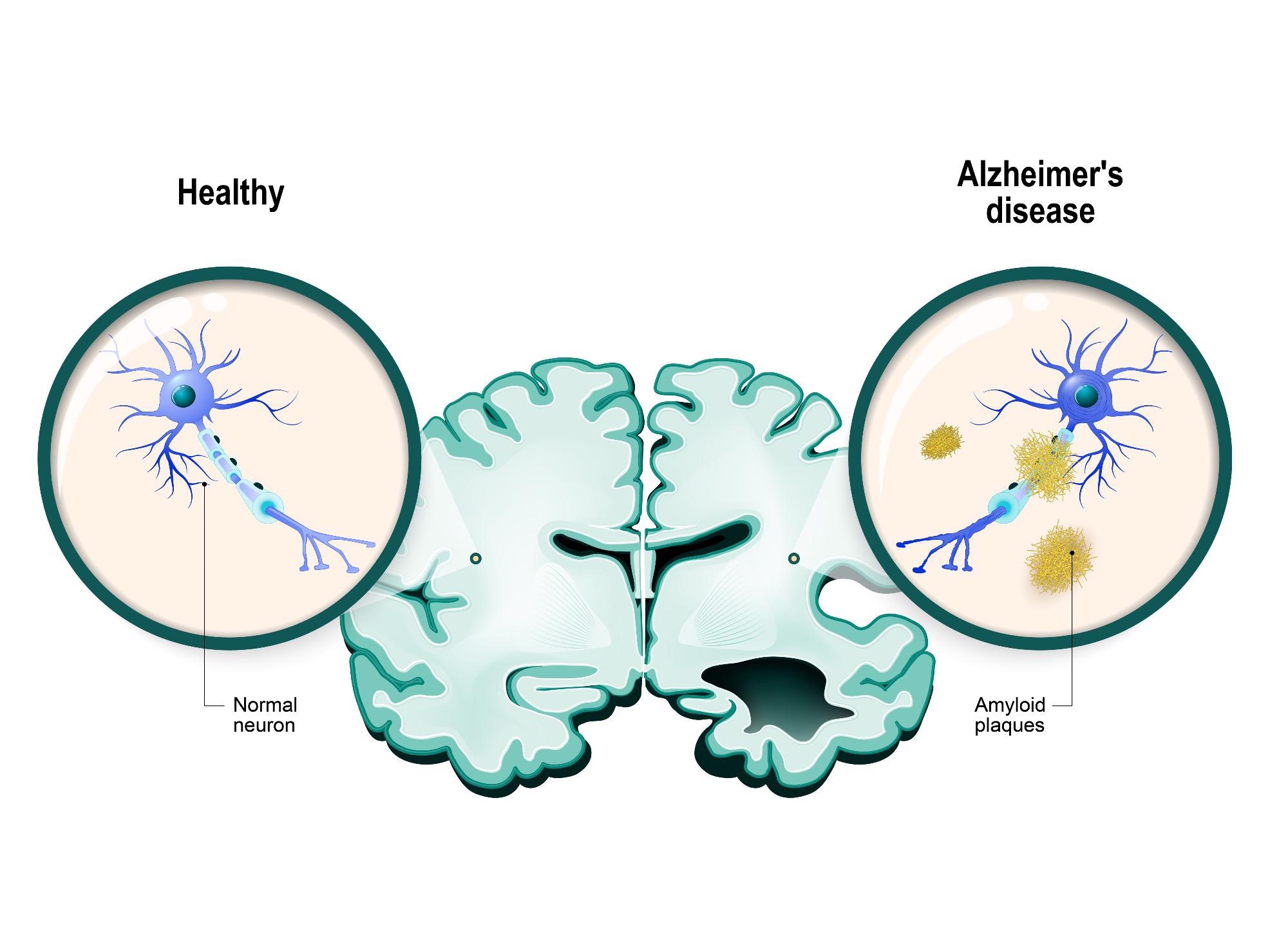 Machine Learning Used to Develop Drugs for Alzheimer’s Disease.