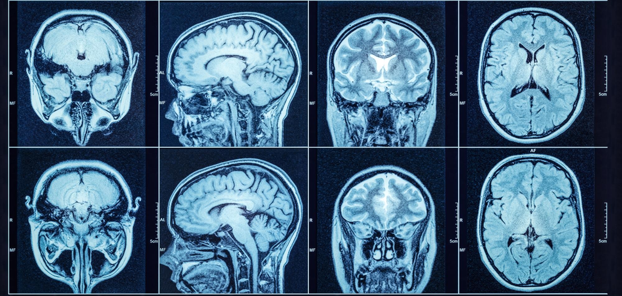 New Machine Learning Tool that Examines Brain MRIs.