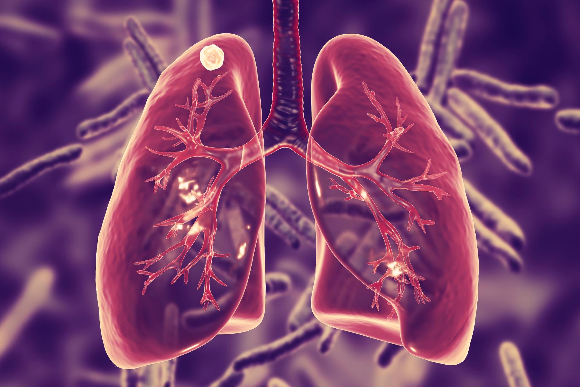 Researchers Use AI to Predict Cancer Risk of Lung Nodules.