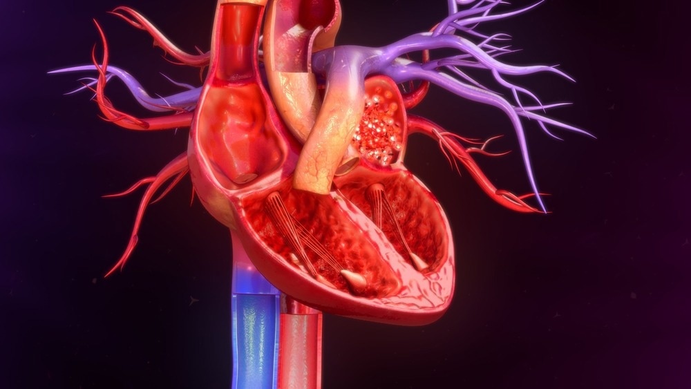 AI Identifies Aortic Stenosis Patients at High Risk of Mortality