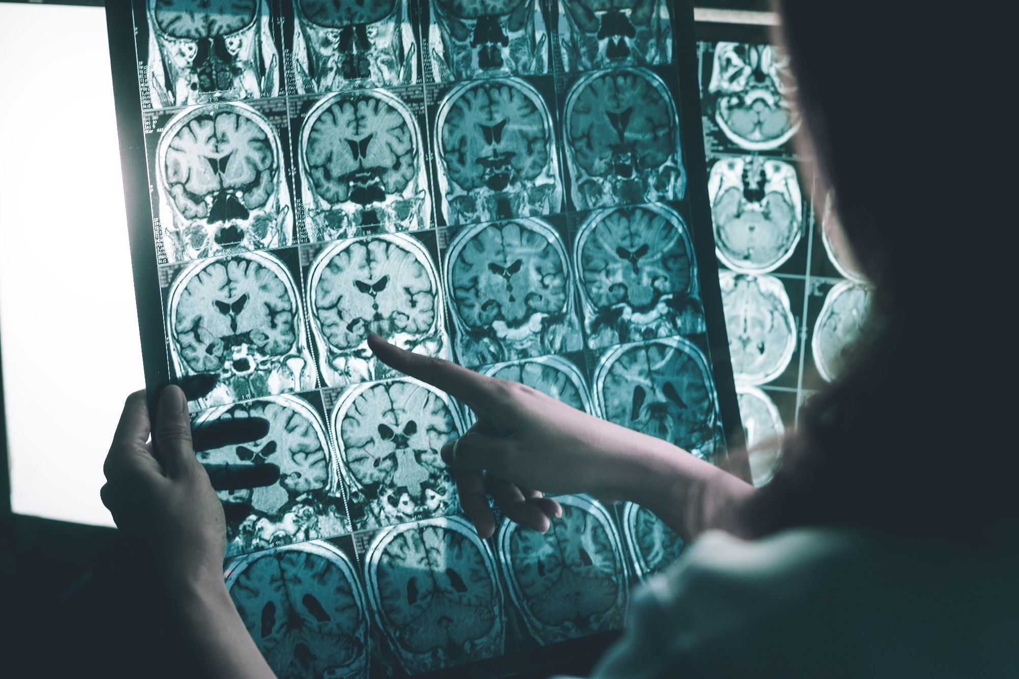 AI for Alzheimer’s: Deep-learning-Based Disease Detection