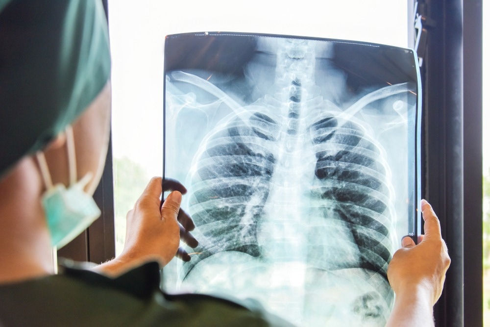 AI Distinguishes Between Normal and Abnormal X-Rays