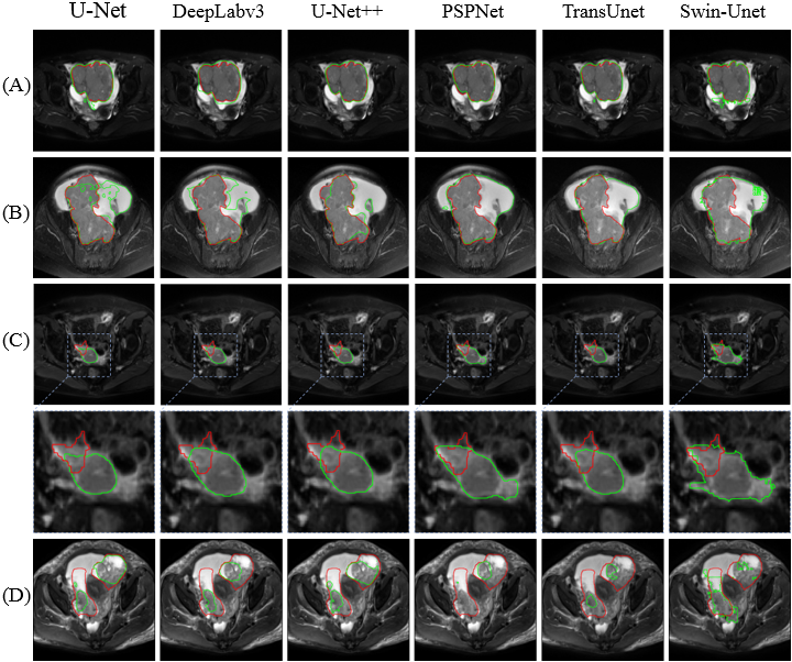Employing Deep Learning-Based Segmentation of Epithelial Ovarian Cancer