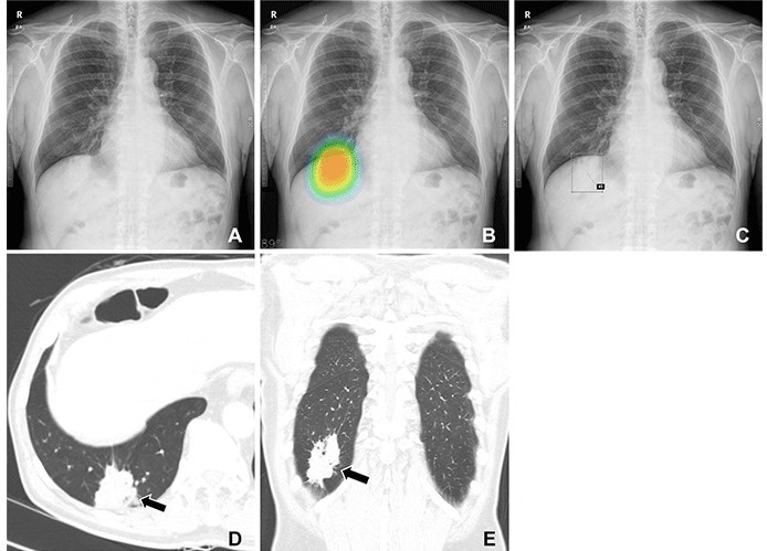 (A–C) Chest radiographs obtained as part of a health checkup in a 71-year-old male patient show reader susceptibility to high diagnostic accuracy artificial intelligence (AI). In the first session without AI, a thoracic radiologist with 16 years of experience read the chest radiograph as a normal radiograph (A). High diagnostic accuracy AI observed potential lung cancer in the radiograph with an 89% CI as indicated by the nodule localization map (B) (as the color changes from blue to red, the probability of the presence of a nodule increases). When presented with the AI suggestion at the second reading session, the radiologist changed the decision and annotated lung cancer in the area that overlapped with the right hemidiaphragm (box annotation) (C). (D, E) Contrast-enhanced chest CT scans show a 6.8-cm lung mass (arrow) with an air bronchogram in the right lower lobe in the axial (D) and coronal (E) planes. This mass was pathologically proven to be an invasive mucinous adenocarcinoma. Therefore, the reader’s decision was incorrect in the first session but correct in the second session after following the AI suggestion.