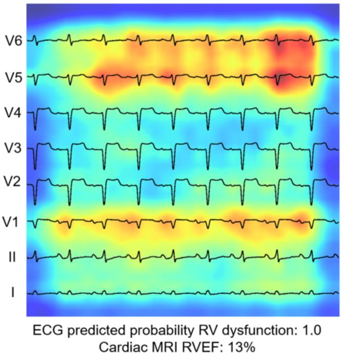 Quantitative Assessment of Right Ventricular Function and Size Based on ECG