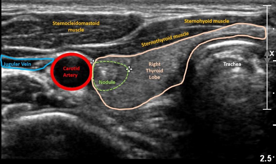 AI Applied to Ultrasound Images of Thyroid Nodules to Predict Risk of Malignancy