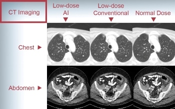 New Artificial Intelligence Technique Allows High-Quality CT Scans with Reduced Radiation Dose
