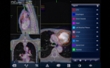Accuray Launches PlanTouch Software Complementing the CyberKnife Robotic System