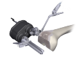 OMNI’s Apex Robotic Technology Enables 1000 Successful Knee Replacements