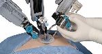 Single-Site Robotic Hysterectomy at UC Medical Center