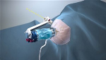 Mazor Robotics Announces First Deep Brain Stimulation Surgery for OCD Performed with Renaissance® Guidance System
