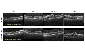 New Algorithm Could Enable Personalized Treatment for Diabetic Macular Edema