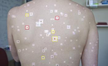 The Artificial Intelligence Tool that can Detect Melanoma