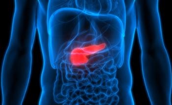 Pancreatic Cancer Risk Detected by AI-Based Model