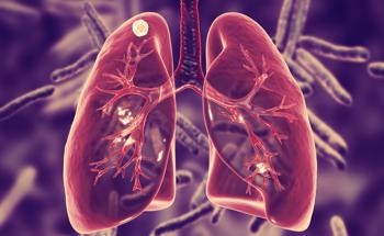 Researchers Use AI to Predict Cancer Risk of Lung Nodules