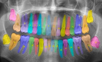 AI: Taking the Subjectivity Out of Dental X-Ray Interpretations