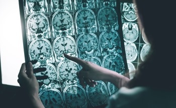 AI for Alzheimer’s: Deep-Learning-Based Disease Detection