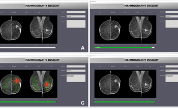 Unraveling the Details of Automation Bias in Mammography
