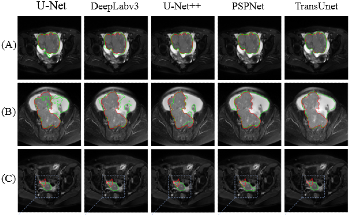 Employing Deep Learning-Based Segmentation of Epithelial Ovarian Cancer