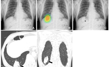 New AI Algorithm With High Diagnostic Accuracy Improves Detection of Lung Cancers
