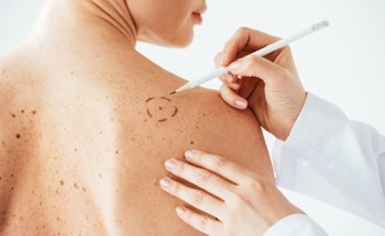 AI Software Achieves 100% Melanoma Detection Rate