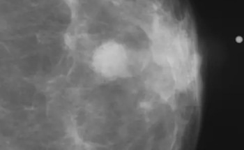AI-Powered Risk Assessment Mitigates Racial Bias in Breast Cancer Diagnosis