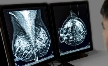 AI Detects Hidden Risk of Breast Cancer in Mammography Images